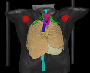 Example of automatic segmentation of organs at risk on a CT scan